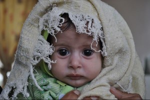 Gharam, 3 mesi, in cura per malnutrizione all'ospedale di Sanaa, Yemen. Copyright: WFP/Abeer Etefa 